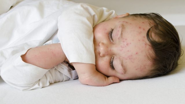 אבעבועות רוח אצל תינוקות